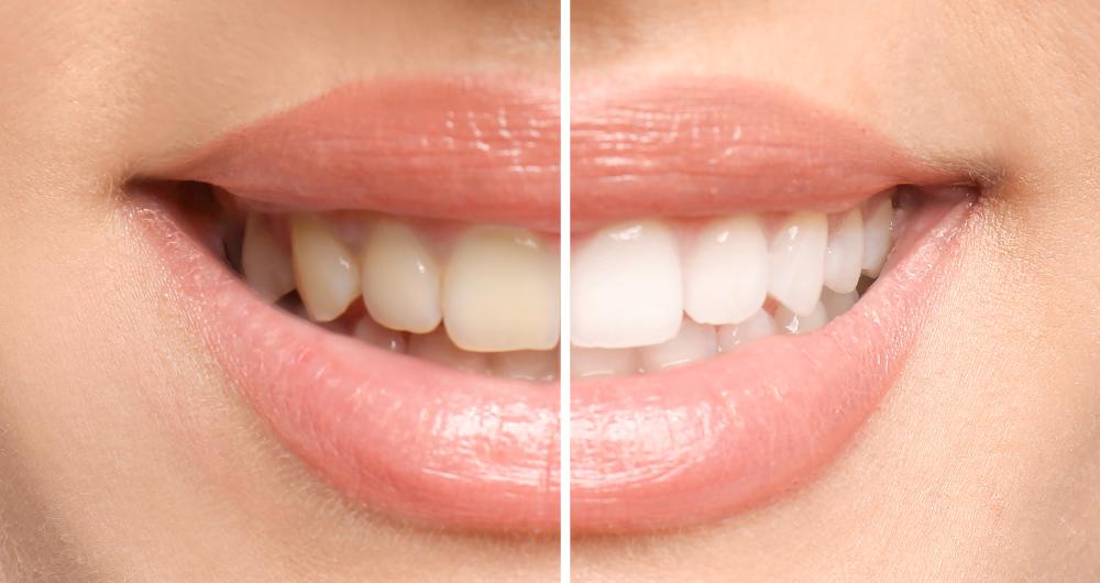 split screen of a smile before and after whitening