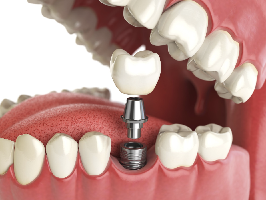 illustration of dental implant