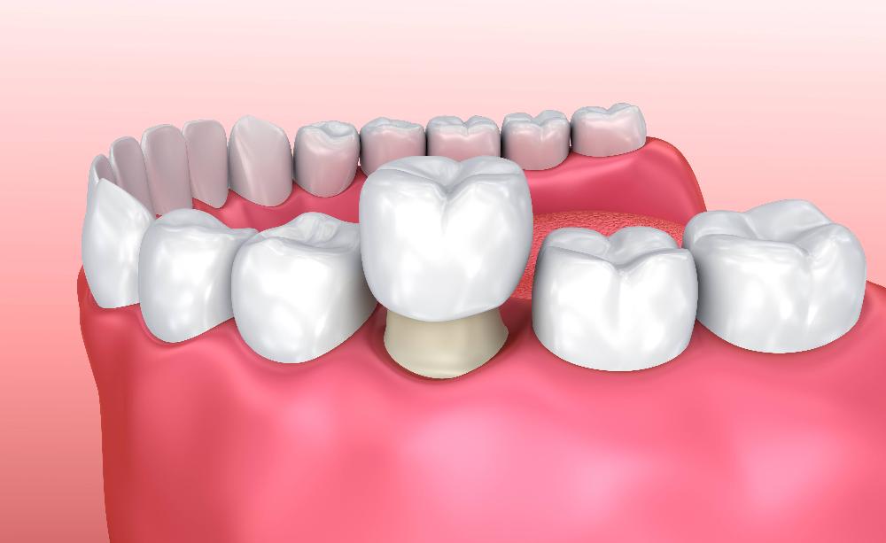 dental crown to cover tooth