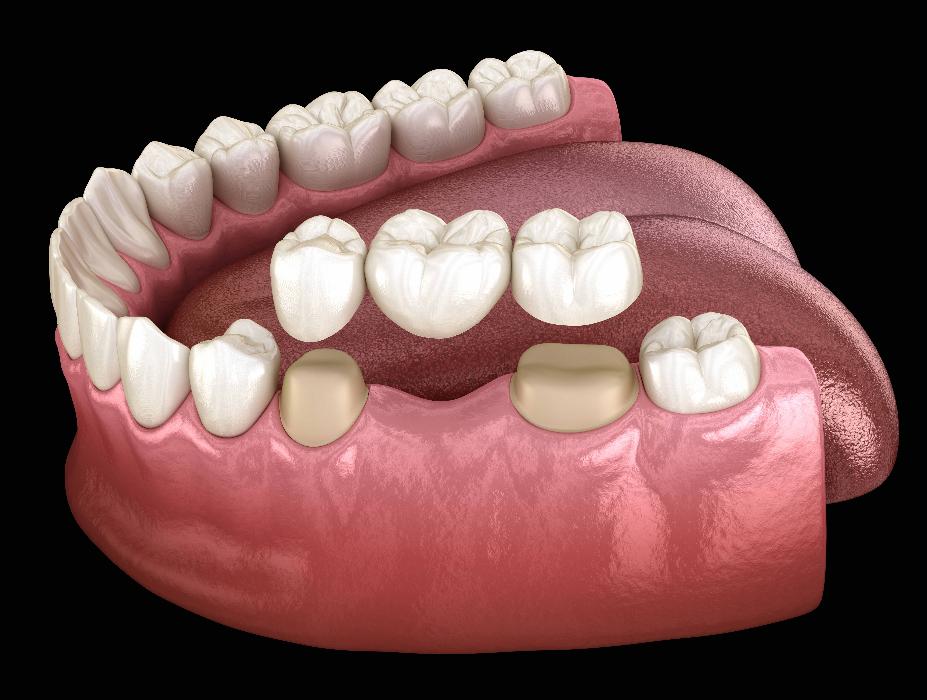 dental bridge in havertown